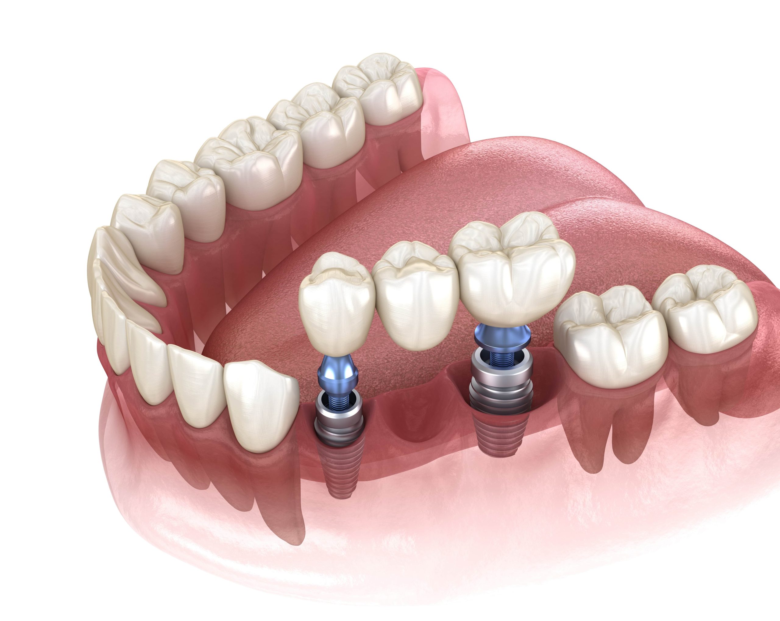 Ar galima dantų implantacija vyresniame amžiuje