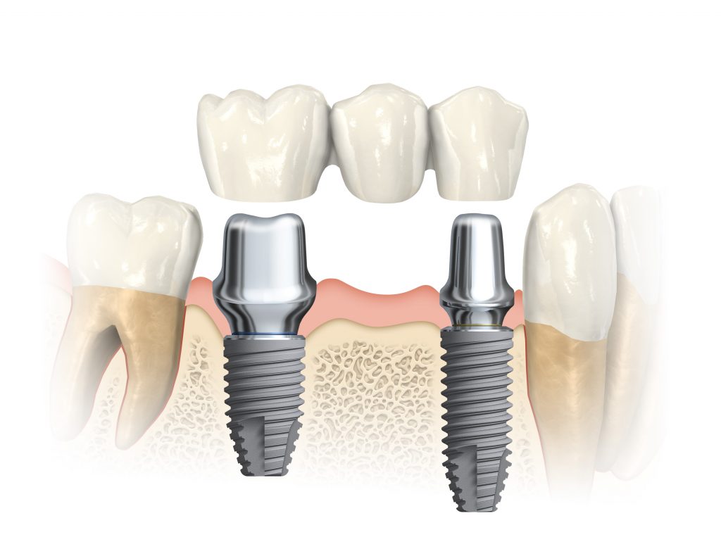 danties implantavimas
