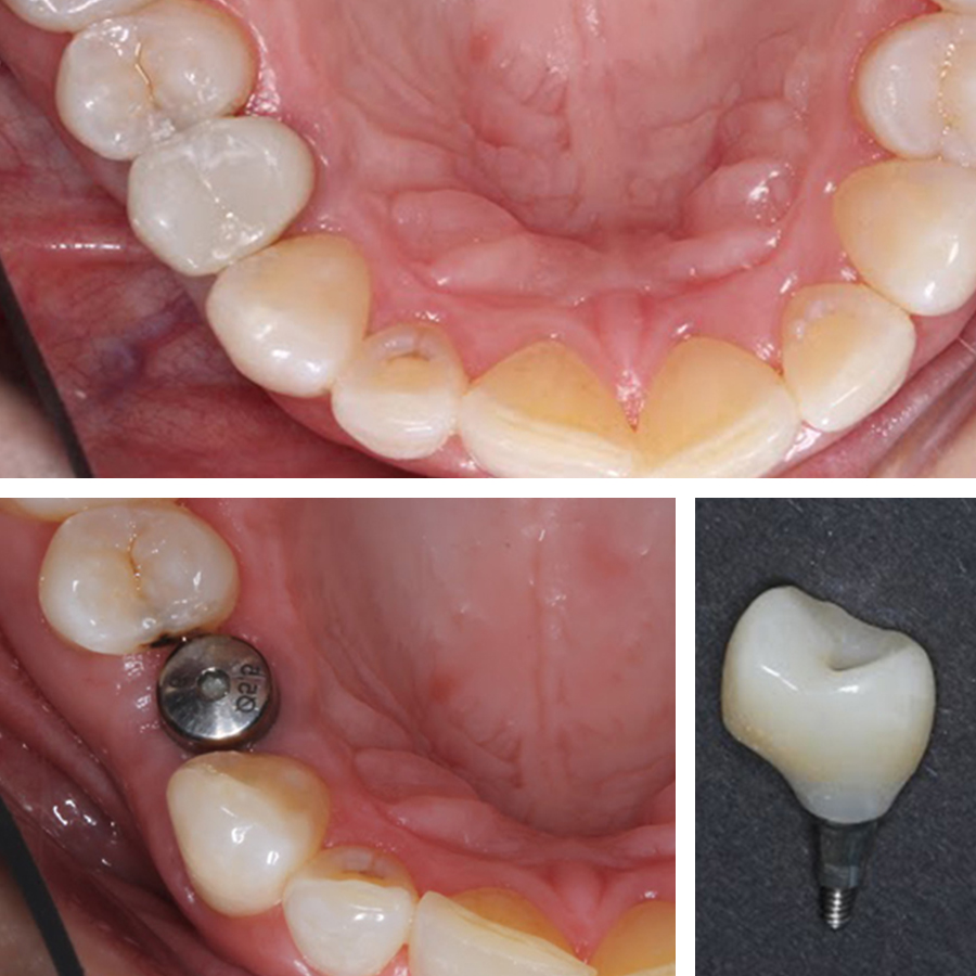 danties implantas akcija
