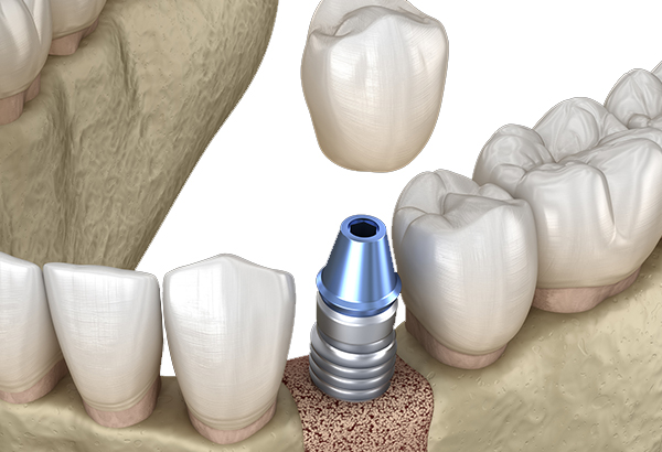 implantas danties kaina